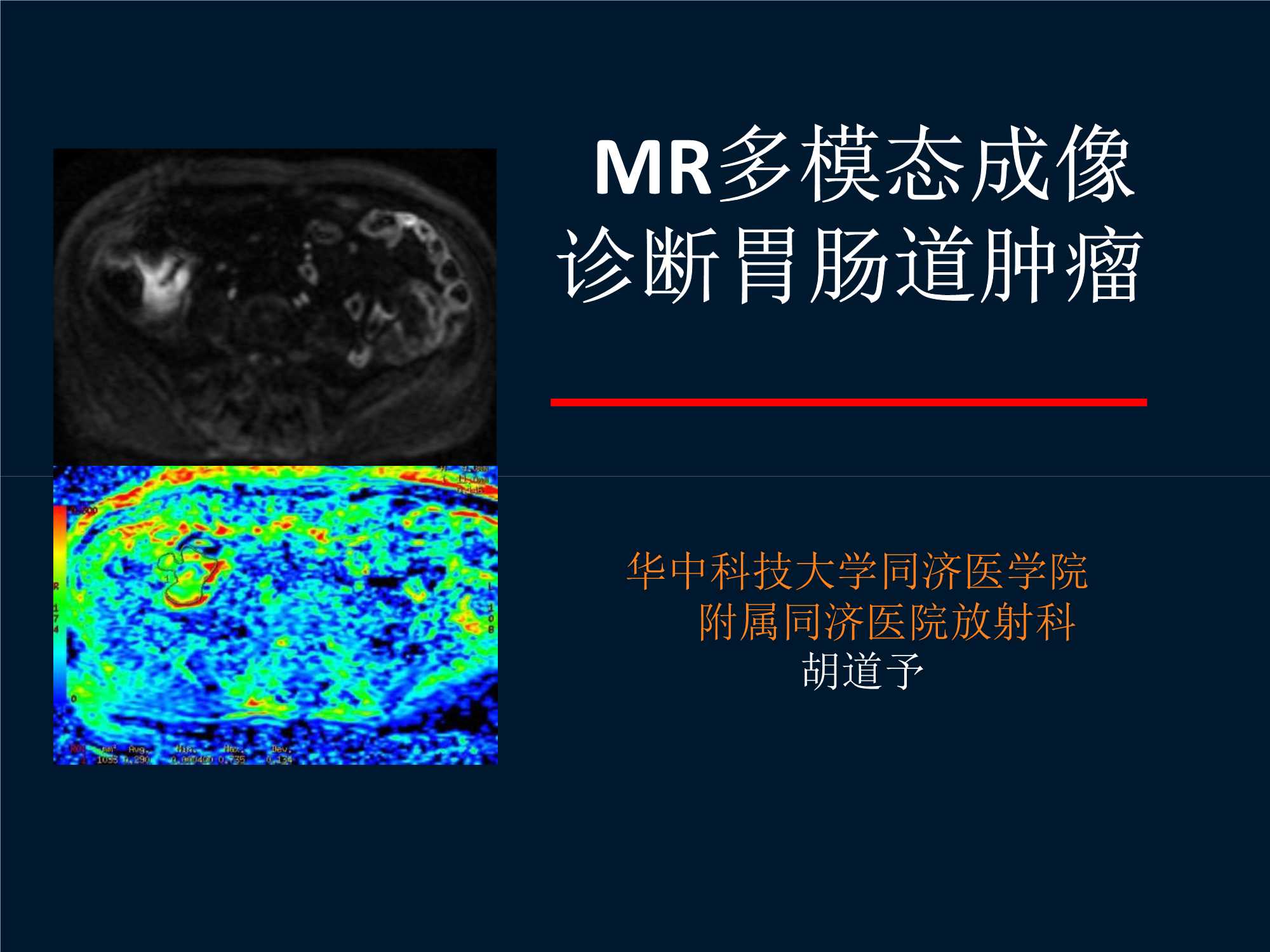 MRI新技术在胃肠疾病中的应用-武汉同济-2017.07-83页